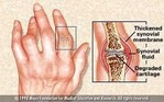 Original Reumartrit Arthritis Rheumatism Gout Arthritis Pain
