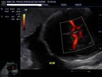 DOPPLER FETAL