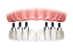 implantes dentales.
