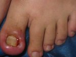 onicocriptosis (uñas encarnadas) de 1er. a 8vo. grado