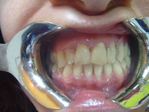 Inicio de tratamiento estética