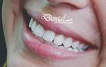 Diseño de la sonrisa